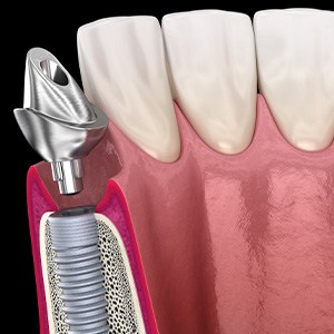 A 3D illustration of a dental implant and its abutment