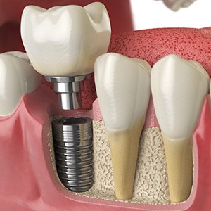 An illustration of a dental implant receiving its final restoration