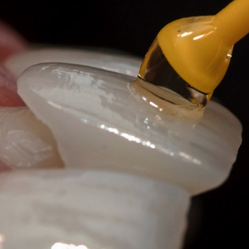 a model of a prepared tooth with a veneer being placed on it