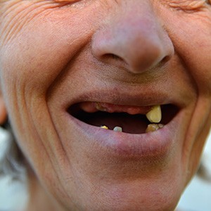 A closeup of a woman with many missing teeth