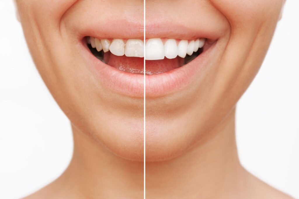 Nose-to-neck view of woman smiling with half her teeth covered in veneers